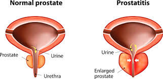 Enlarged Prostate and Natural Remedies